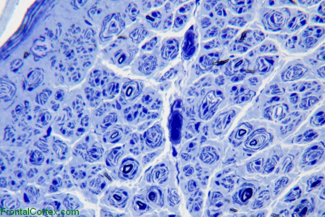 Hereditary sensory and motor neuropathy, type 1, sural nerve, toluidine blue x 400